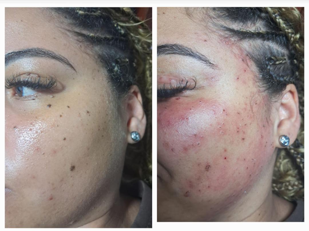 Botox em Duque de Caxias